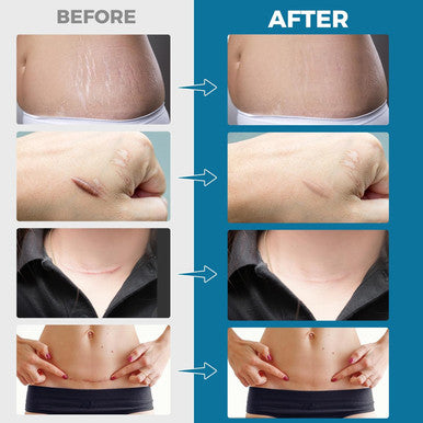 Scar Away Silicone Scar Sheets, Silicone Scar Tape (1.6 X 120 Roll), Scar Removal Sheets, Scar Strips For Surgical Scars, Stretch Marks, C-Section, Keloid, Tummy Tuck, Burn, Old/Scars, Reusable