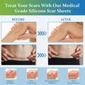 Silicone Scar Sheets, Medical Grade Silicone Scar Tape, Reusable Scar Removal Strips For Surgical Scars, C-Section, Keloid, Tummy Tuck, Burn, Acne, Surgery Scars Treatment