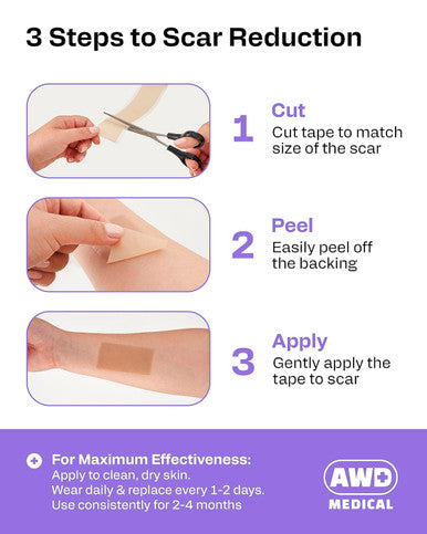 Awd Silicone Scar Sheets For Surgical Scars - Medical Grade Silicone Scar Tape For C Section, Tummy Tuck Tape, Keloid Treatment - Silicone Skin Patches After Surgery Must Haves (1.6" X 120" Roll)