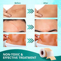 Silicone Scar Sheets,Silicone Scar Tape(1.6"X 60" Roll-1.5M), Reusable And Effective Scar Removal Sheets, Silicone Scar Removal Sheets For Surgical Scars,Healing Keloid, C-Section, Tummy Tuck