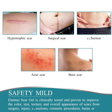 Medical Grade Silicone Scar Sheets, Silicone Scar Tape (1.6 X 60 ), Scar Removal Strips For Acne Scars C-Section & Keloid Surgery Scars Sheets Treatment Sheets - 6-8 Month Supply