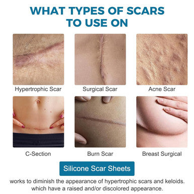 Scar Away Silicone Scar Sheets, Silicone Scar Tape (1.6 X 120 Roll), Scar Removal Sheets, Scar Strips For Surgical Scars, Stretch Marks, C-Section, Keloid, Tummy Tuck, Burn, Old/Scars, Reusable
