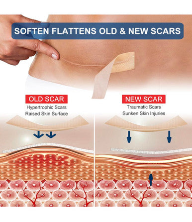 Medical Grade Silicone Scar Sheets, Silicone Scar Tape (1 X 120 , Pack Of 2), Professional Scar Removal Treatment, Reusable Silicone Scar Strip For Keloid, C-Section, Surgery, And Wrinkles