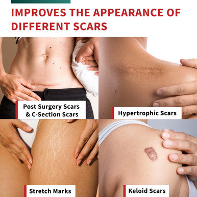 Medical Grade Silicone Scar Tape Advanced Adhesive Formulation (1.6" X 118") Scar Removal Away Strips For Surgical Scars, Silicone Tape & Keloid Scar Treatment, Reusable Silicone Scar Sheets