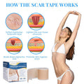 Silicone Scar Sheets, Silicone Scar Tape Roll (60 X1.6 ), Professional Scars Removal Treatment, Scar Silicone Strips, Reusable Silicone Scar Strips Type For Keloid, C-Section, Surgery, Keloid, Acne