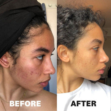 Porefavor Acne Supplements Includes Dim, Zinc + 10 Actives Targeting The 4 Stages Of Acne Development Clear Skin Vitamins For Spots, Blemishes & Oil Control, For Women, Men, & Teens (1 Month Supply)