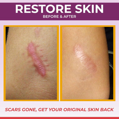 Medical Grade Silicone Scar Sheets - Non-Irritating Scar Strips For Surgical Scars, C-Section, Tummy Tuck, And Keloid - Premium Soft Gel Strips For Pain-Scar Removal (1.6In X 120In)