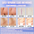 Silicone Scar Sheets (1.6''X60''Roll-1.5M) Reusable Silicone Scar Tape For Surgical Scars, Cesarean Section, Abdominal Retraction, Scar Removal, Scar Protrusion Removal.Waterproof.Waterproof Material