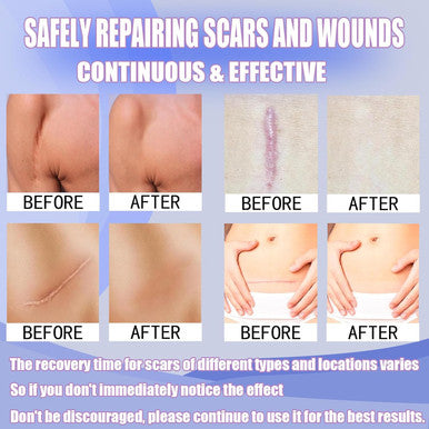 Silicone Scar Sheets (1.6''X60''Roll-1.5M) Reusable Silicone Scar Tape For Surgical Scars, Cesarean Section, Abdominal Retraction, Scar Removal, Scar Protrusion Removal.Waterproof.Waterproof Material