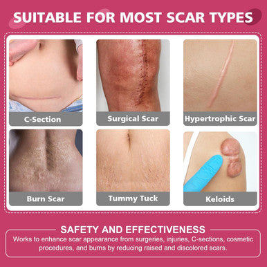 Silicone Scar Sheets,Silicone Scar Tape,Scar Tape For Surgical Scars,C-Section,Tummy Tuck,Keloid Bump Removal (1.6"X 59" Roll-1.5M-Pigment Reduction Enhanced Version-Pink)