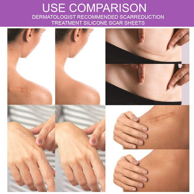 Silicone Scar Tape For Scar Treatment, Advanced Scar Removal Sheets, Soften And Flattens Old Scars And Scars Which Resulting From Surgery, Acne, Injury, Burns, C-Section And More (1.6 X 60 )
