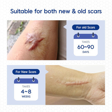 Murasaki Beauty Silicone Scar Tape & Sheets Removal On Keloids, Burns, Abrasion, C-Section, And Surgical Scars Safe For Adults And Children 1.6"X 60" Roll-4 X 1.5M(Pack Of 1) (1.6X60Inch)