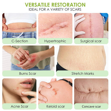 Auslka Silicone Scar Sheets(1.6"X 120" Roll-3M), Silicone Scar Tape, Scar Strips, Professional Silicone Scar Tape For C-Section, Tummy Tuck, Keloid, And Scar Patch