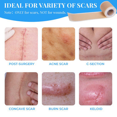 Silicone Scar Sheets, Silicone Scar Tape Roll (60 X1.6 ), Professional Scars Removal Treatment, Scar Silicone Strips, Reusable Silicone Scar Strips Type For Keloid, C-Section, Surgery, Keloid, Acne