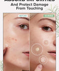 I Dew Care Hydrocolloid Acne Pimple Patch Trio - Meet Your Patch Set + Tweezer - Tweeze The Day | Precision Stainless Steel, Professional Hair Beauty Tool Bundle