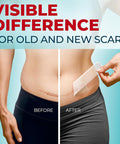 Medical Grade Silicone Scar Sheets - Transparent - 6Pk (5.7 X1.6 ) - Visible Difference On Surgical & Keloid Scars - Reusable C-Section Scar Silicone Strips - Easy To Use Silicone Sheets For Scars