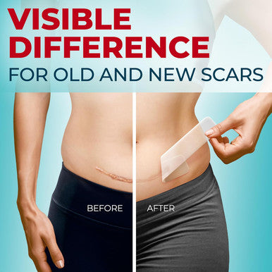 Medical Grade Silicone Scar Sheets - Transparent - 6Pk (5.7 X1.6 ) - Visible Difference On Surgical & Keloid Scars - Reusable C-Section Scar Silicone Strips - Easy To Use Silicone Sheets For Scars