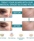 Medical Grade Silicone Scar Sheets, Silicone Scar Tape (1.6 X 60 ), Scar Removal Strips For Acne Scars C-Section & Keloid Surgery Scars Sheets Treatment Sheets - 6-8 Month Supply