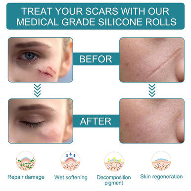 Medical Grade Silicone Scar Sheets, Silicone Scar Tape (1.6 X 60 ), Scar Removal Strips For Acne Scars C-Section & Keloid Surgery Scars Sheets Treatment Sheets - 6-8 Month Supply