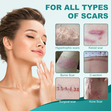 Silicone Scar Sheets, Silicone Scar Tape(1.6"X 158"), Scar Tape For Scar Removal Treatment, Reusable Silicone Scar Strips For Surgical, C-Section, Keloid, Burn, Acne, Surgical Scars