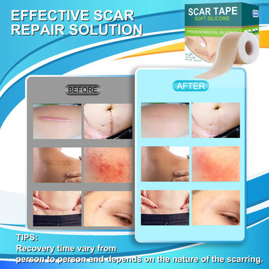 Medical Grade Silicone Scar Tape For Surgical Scars (1.6" X 120" - 3M) Professional Silicone Scar Sheets Scar Treatment For Face Wrinkles, C Section Recovery, Keloid Bump Removal Silicone Scar Patches