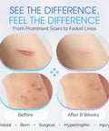Advanced Scar Treatment - Medical Grade Silicone Scar Sheets, Long Water-Resistant Silicone Scar Tapes For Surgical Scars, Stretch Marks, Keloid Bump - 7 Inch, 12 Strips