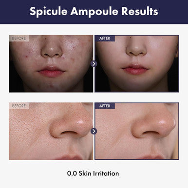Real Spicule Ampoule With Spicule 30,000 Shot, Niacinamide, Amino Acid And Panthenol, Pore Minimizer, Exfoliating, Micro-Sized, Needle-Shaped Design, Korean Skincare, 30Ml, 1.01 Fl. Oz.