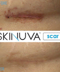Skinuva Next Generation Scar Cream - Advanced Scar Cream Formulated With Growth Factors (1 Oz)