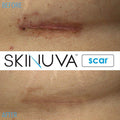 Skinuva Next Generation Scar Cream - Advanced Scar Cream Formulated With Growth Factors (1 Oz)