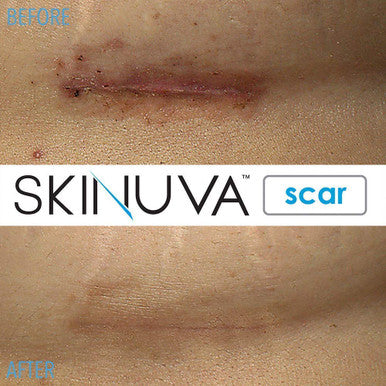 Skinuva Next Generation Scar Cream - Advanced Scar Cream Formulated With Growth Factors (1 Oz)