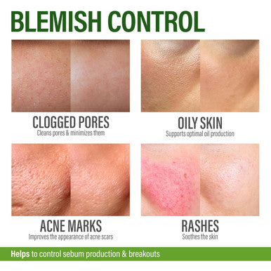 Acne Supplements For Clear Skin With Biotin, Zinc, Vitamin A & Niacin - Acne Pills For Acne Scar Treatment - Cystic Acne Treatment With Probiotics For Gut Health & Glowing Skin - Made In Usa - 60 Caps