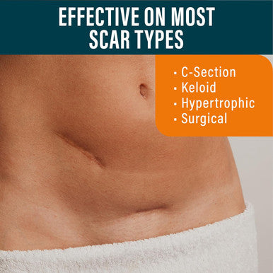 Nuvadermis Silicone Scar Sheets Extra Long Medical-Grade Scar Sheets For C-Section, Tummy Tuck, Keloid, And Surgical Scars Reusable And Effective Pack Of 4 Medium Tone