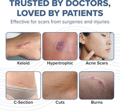 Prosil Silicone Scar Stick 4.25G Effective Scar Treatment With Premium-Grade Silicone Compact, Mess-Free, Glide-On Application For Convenient Scar Therapy Gentle On All Skin Types & Kids