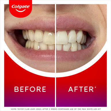Colgate Max White Ultimate at Home LED Teeth Whitening Kit Enamel Safe Reverses up to 20 Years of Stains Whitening Pen and Smartphone Powered LED Whitening Light Developed by Dental Experts 1 Pack