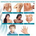 Newgel+ Advanced Silicone Scar Treatment Sheets For Breast Reconstruction Surgery "Anchor" Scars, 2 Breast Anchors And 2 Areola Circles (4-Count) - Beige