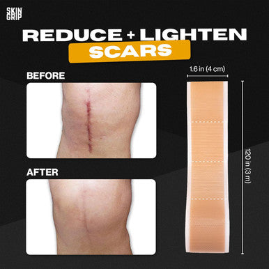 Skin Grip Medical Grade Silicone Scar Tape 1.6"X120" Roll - Increased Strength & Reduced Irritation - Silicone Scar Sheets For Face, Surgical Scars, C-Section, Keloid Treatment, Tummy Tuck, Burn, Acne