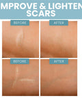 Eva Naturals Soft Medical Grade Silicone Tape For Scars (1.6 X 120 ) - Reduce The Appearance Of Surgical C Section Hypertrophy, Keloid Scars, & Acne Scars - Silicone Scar Tape For Surgical Scars Silicone Scar