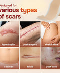 10 Pack Silicone Sheets For Scars, Post Surgery, Tummy Tuck, C-Section Recovery, Keloid Bump Removal, Stretch Marks Removal, Face Acne, Silicone Tape For Scars, Silicone Scar Sheets, (6 X 1.6 )