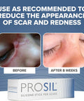 Prosil Silicone Scar Stick 4.25G Effective Scar Treatment With Premium-Grade Silicone Compact, Mess-Free, Glide-On Application For Convenient Scar Therapy Gentle On All Skin Types & Kids