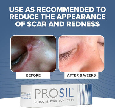 Prosil Silicone Scar Stick 4.25G Effective Scar Treatment With Premium-Grade Silicone Compact, Mess-Free, Glide-On Application For Convenient Scar Therapy Gentle On All Skin Types & Kids