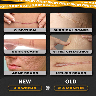 Skin Grip Medical Grade Silicone Scar Tape 1.6"X120" Roll - Increased Strength & Reduced Irritation - Silicone Scar Sheets For Face, Surgical Scars, C-Section, Keloid Treatment, Tummy Tuck, Burn, Acne