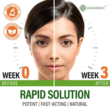 Acne Supplements For Clear Skin With Biotin, Zinc, Vitamin A & Niacin - Acne Pills For Acne Scar Treatment - Cystic Acne Treatment With Probiotics For Gut Health & Glowing Skin - Made In Usa - 60 Caps