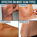 Nuvadermis Silicone Scar Tape For Surgical Scars - 120" X 1.5" Roll - Extra Long Medical Grade Silicone Scar Tape For C-Section, Tummy Tuck, Keloid, And Surgical Scars - Reusable Tape Strips - 1 Pack