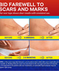 Medical Silicone Scar Tape For Scars: Medical Grade Scar Sheets Reduces The Appearance Of Scars From Surgical Acne Stitches Burns More 1.6"X 120"