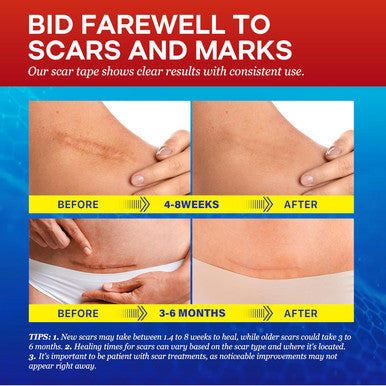 Medical Silicone Scar Tape For Scars: Medical Grade Scar Sheets Reduces The Appearance Of Scars From Surgical Acne Stitches Burns More 1.6"X 120"