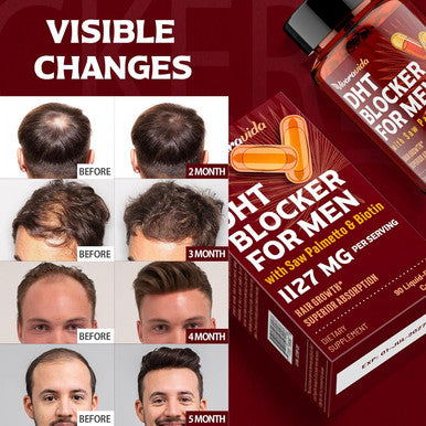 Dht Blocker For Men Hair Growth Supplement With Saw Palmetto & Biotin - Hair Growth Vitamins - Hair Regrowth - Natural Hair Loss Supplements Liquid-Filled - Proprietary Herbal Blends (90 Capsules)