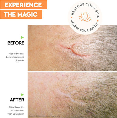 Strataderm Professional Scar Therapy Gel Old And Scars From General Surgery, Trauma, Wounds, Burns, Bites, Acne & Skin Disease Reduces Redness, Discoloration, Discomfort & Itch 5G (0.17Oz)