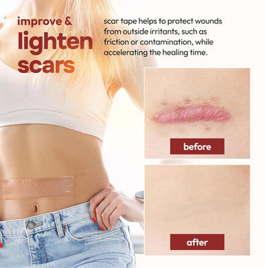10 Pack Silicone Sheets For Scars, Post Surgery, Tummy Tuck, C-Section Recovery, Keloid Bump Removal, Stretch Marks Removal, Face Acne, Silicone Tape For Scars, Silicone Scar Sheets, (6 X 1.6 )